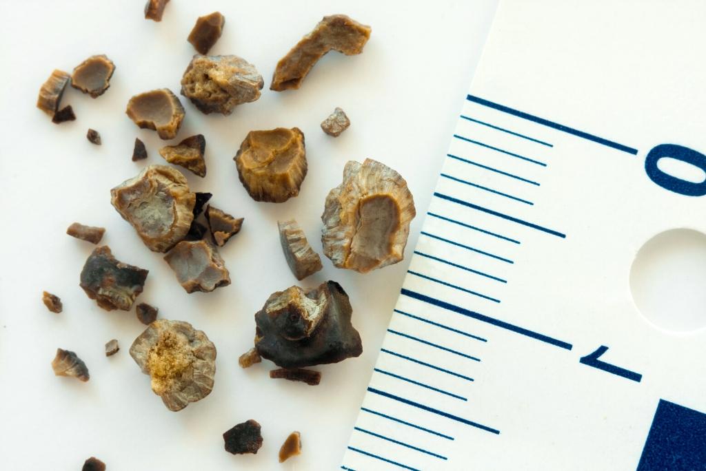 Learn About Kidney Stones | Yakima Urology Associates PLLC