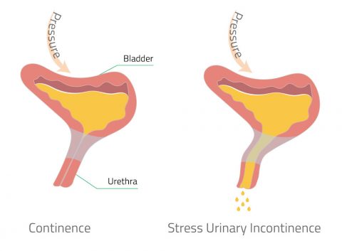 urinary incontinence affect