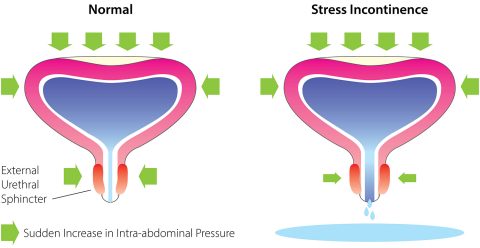 urinary incontinence
